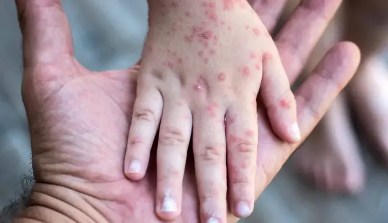 Brote de Sarampión repunta en Puebla: ya son 82 casos